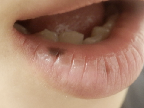 下口唇にある褐色調の色素斑が見られます。