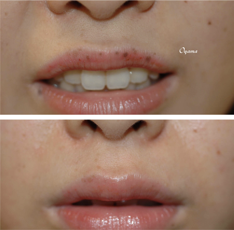 上口唇に多数の細かい色素斑が見られます。