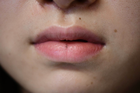 下口唇中央に小さいメラニンの集まりが縦に見られます。