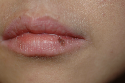 これは30代、アトピー性皮膚炎の方の下口唇の大きなシミです。