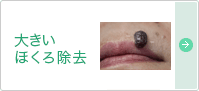 大きいほくろ除去