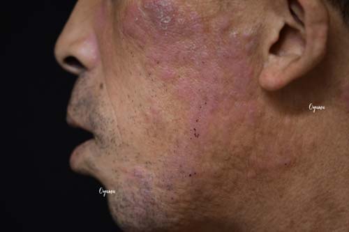新薬のJAK阻害剤であるリンヴォックを投与