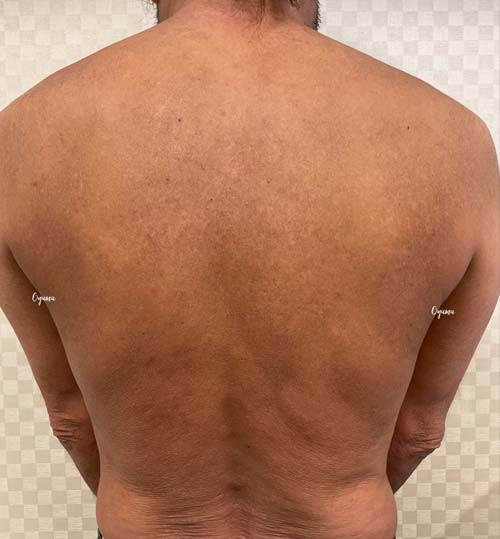 新薬のJAK阻害剤であるリンヴォックを投与