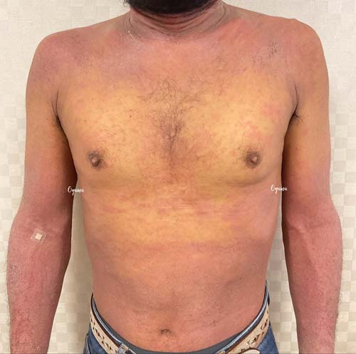新薬のJAK阻害剤であるリンヴォックを投与