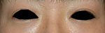 ヒアルロン酸注入による目の下のくぼみ目の解消