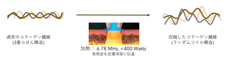 コラーゲン繊維