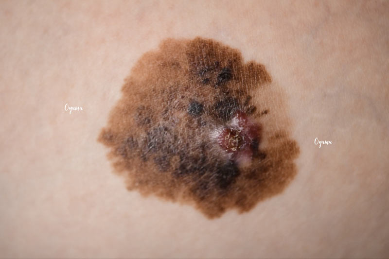 悪性黒色腫(メラノーマ)