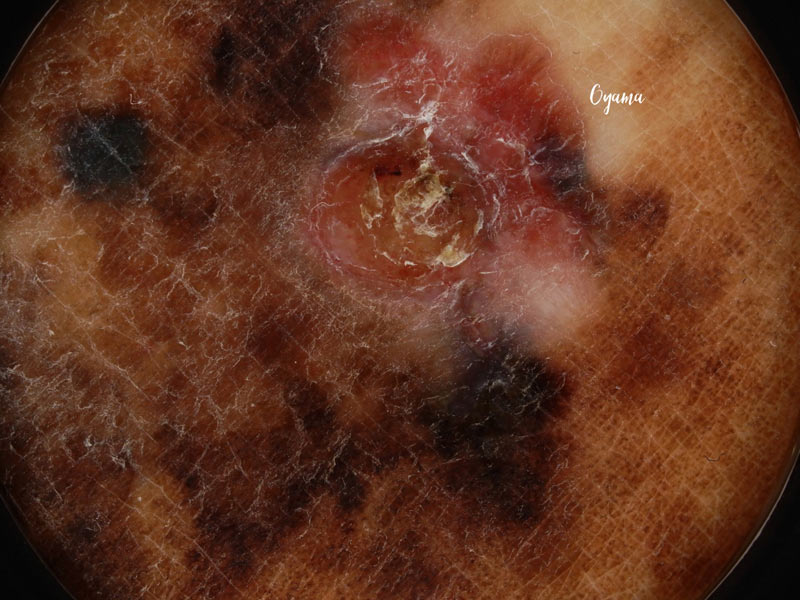 悪性黒色腫(メラノーマ)ダーモスコピー所見