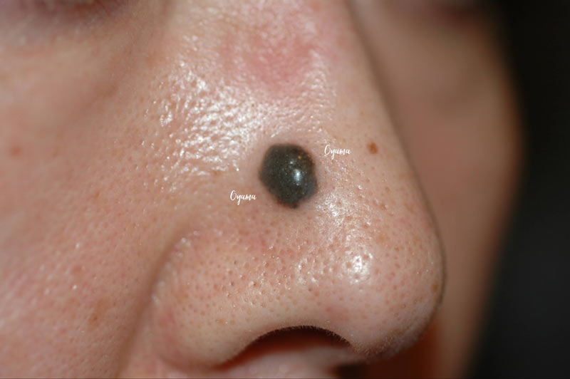 通常のほくろの色調