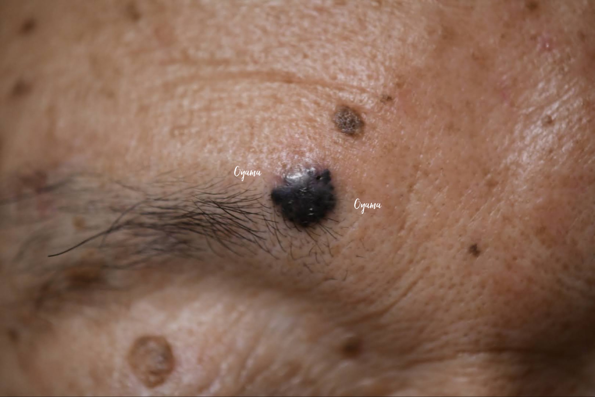 大きいほくろ除去