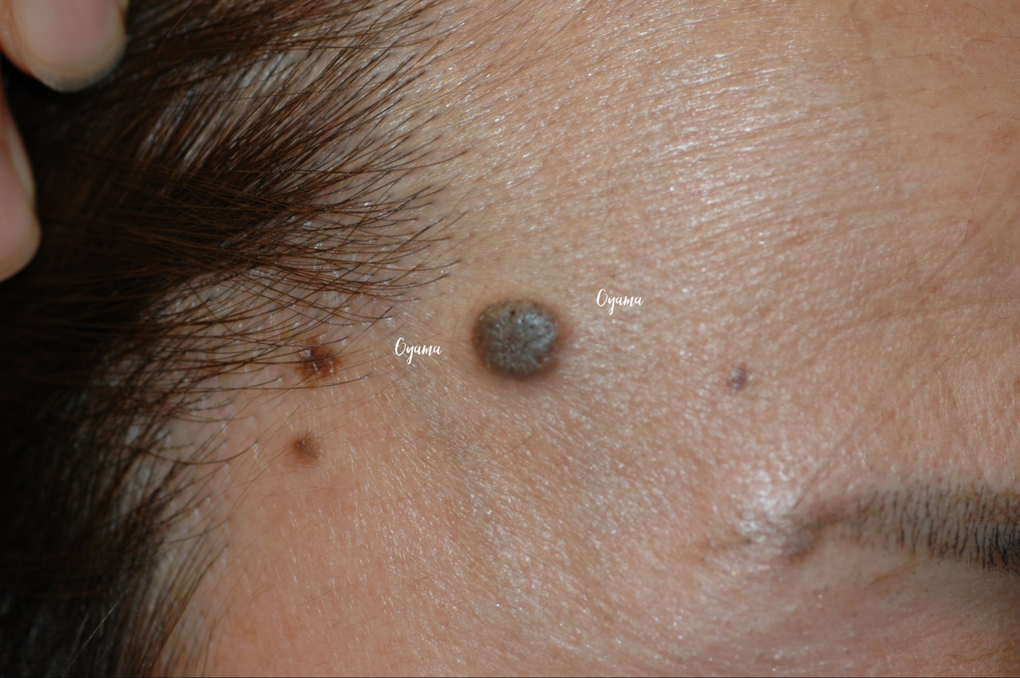 大きいほくろ除去