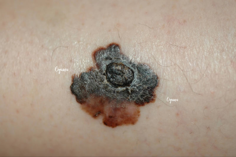 大きいほくろ除去