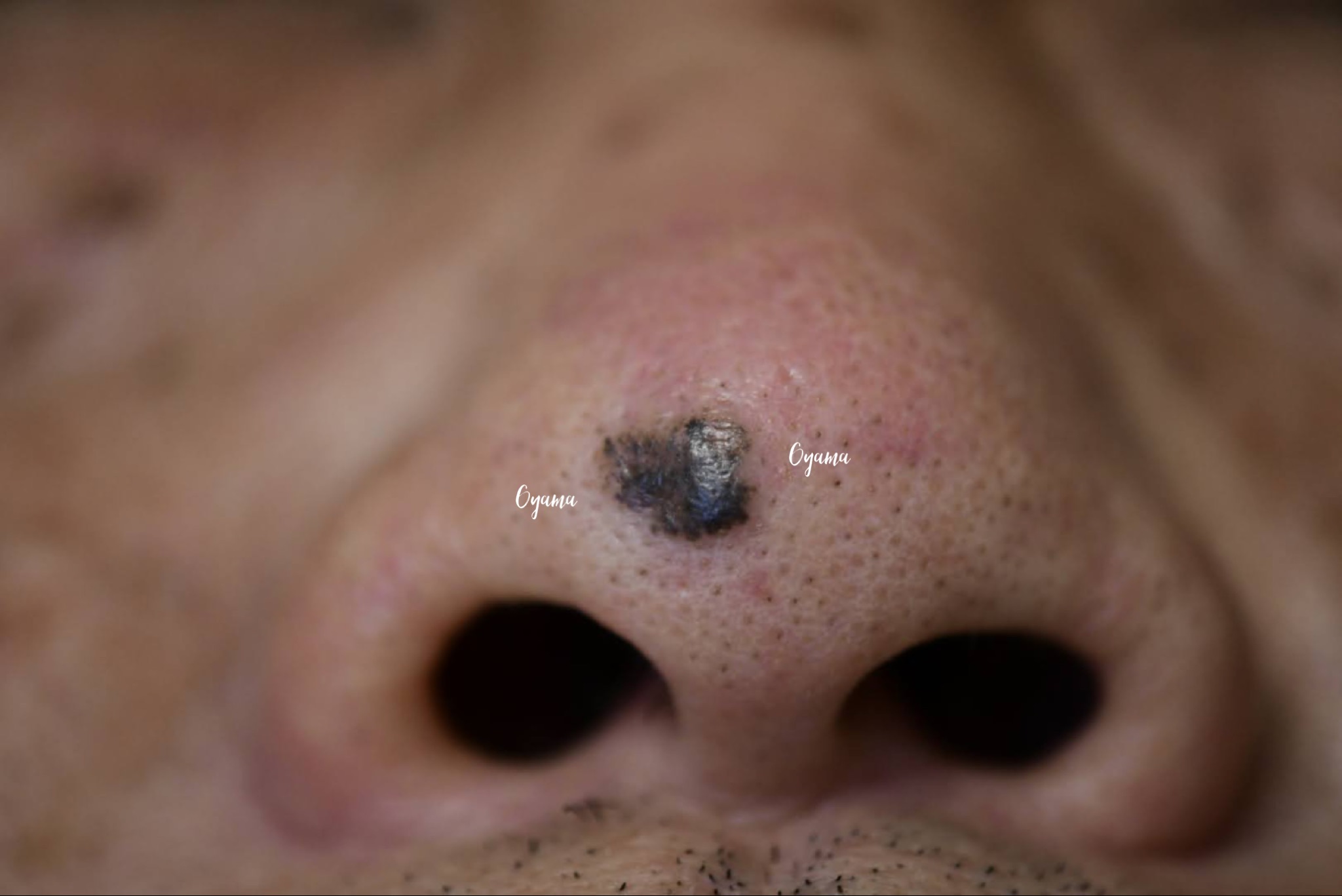 大きいほくろ除去