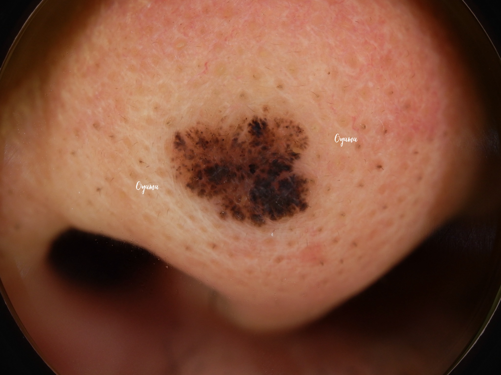 大きいほくろ除去