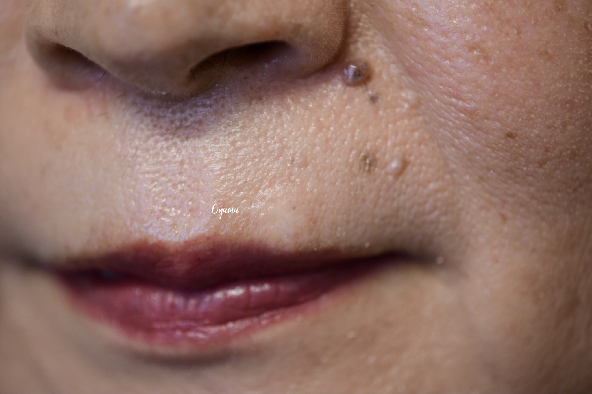 大きいほくろ除去