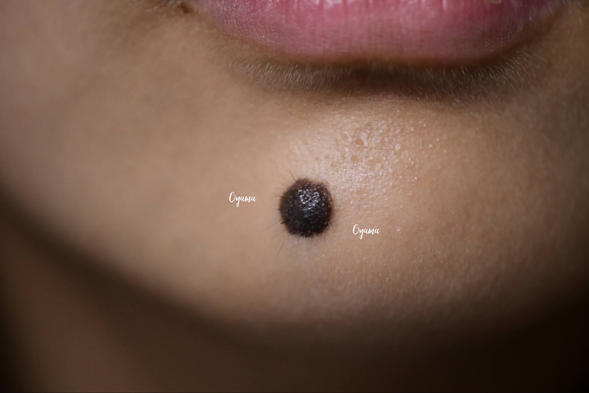 大きいほくろ除去