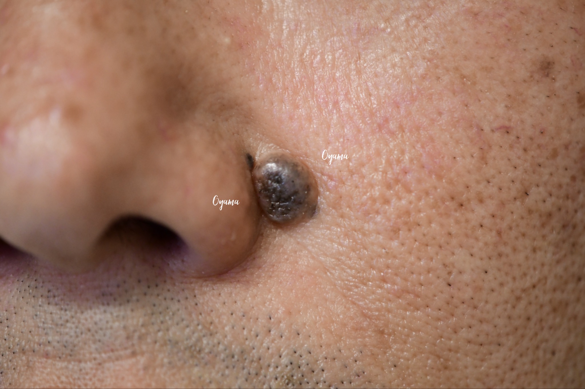 大きいほくろ除去