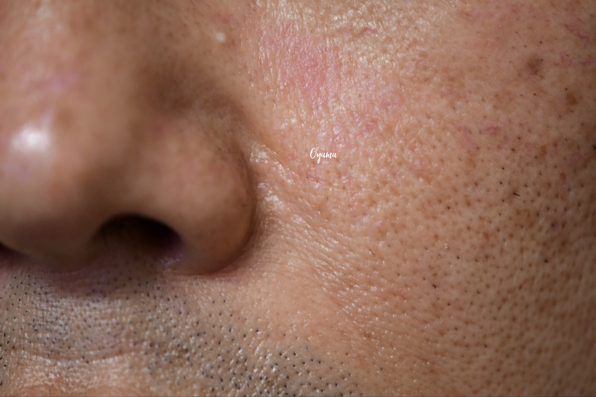 大きいほくろ除去