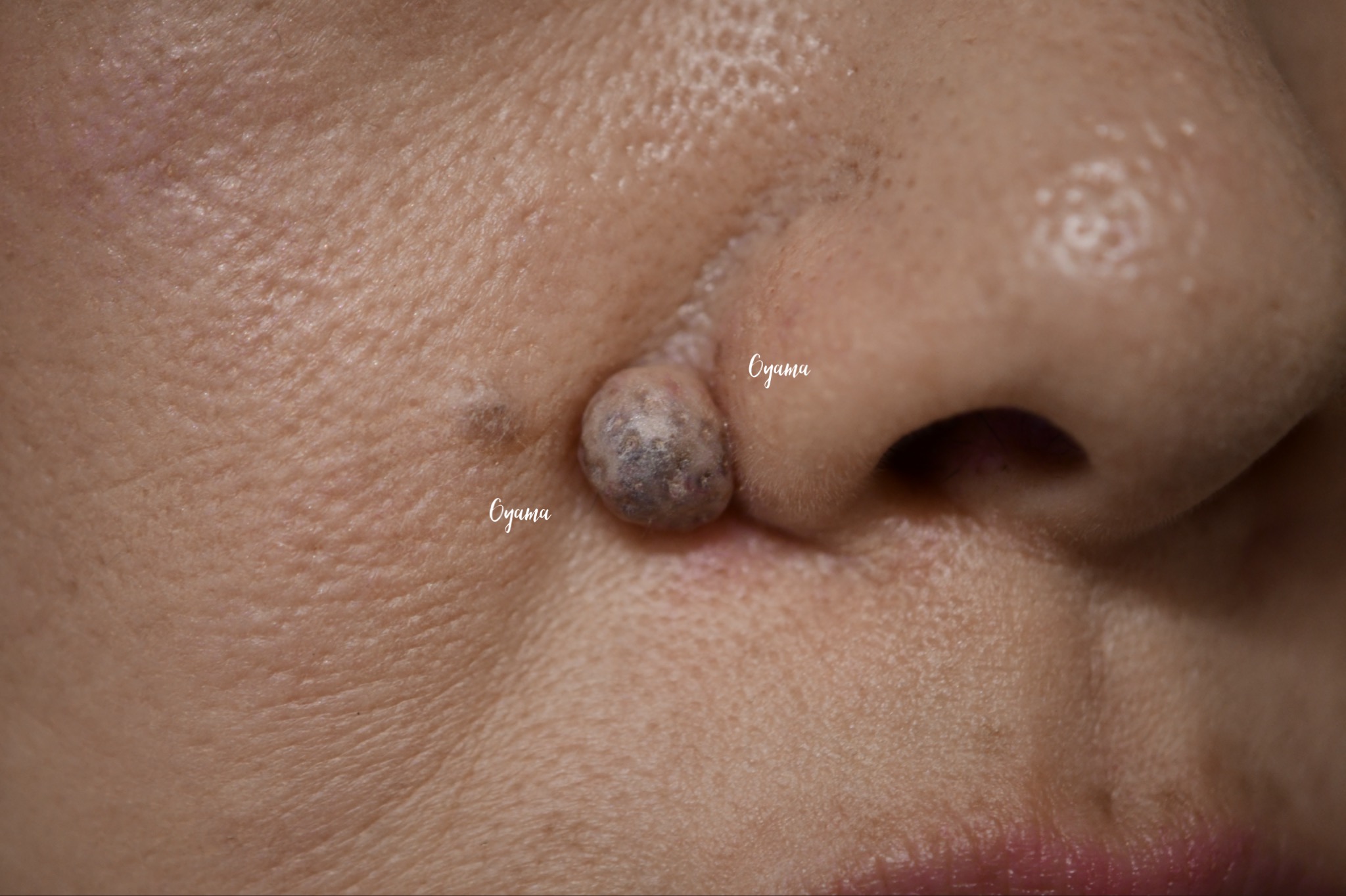 大きいほくろ除去