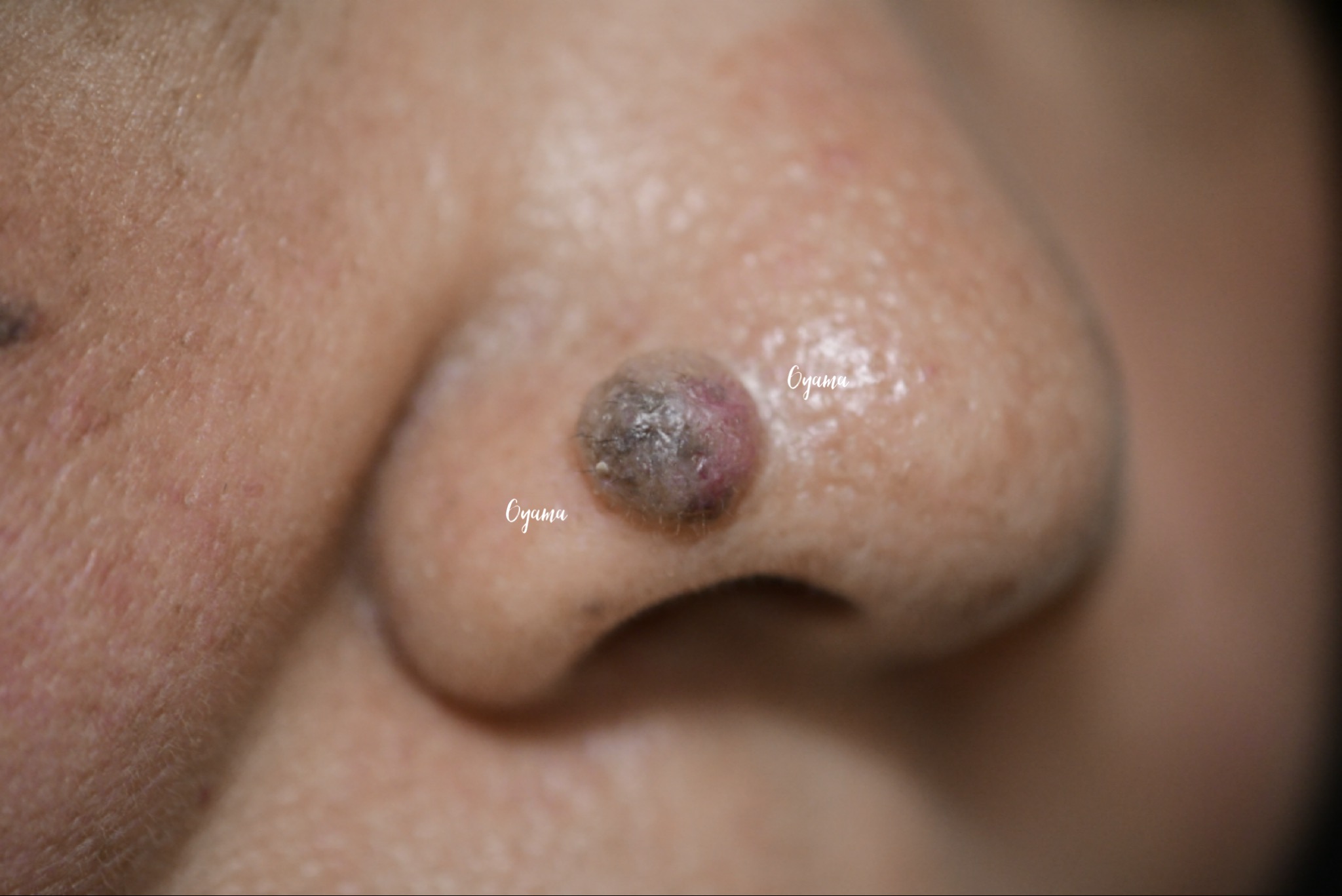 大きいほくろ除去