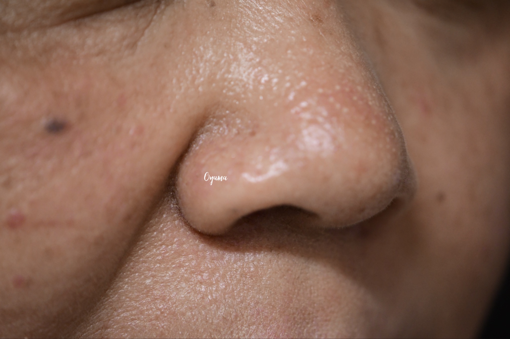 大きいほくろ除去