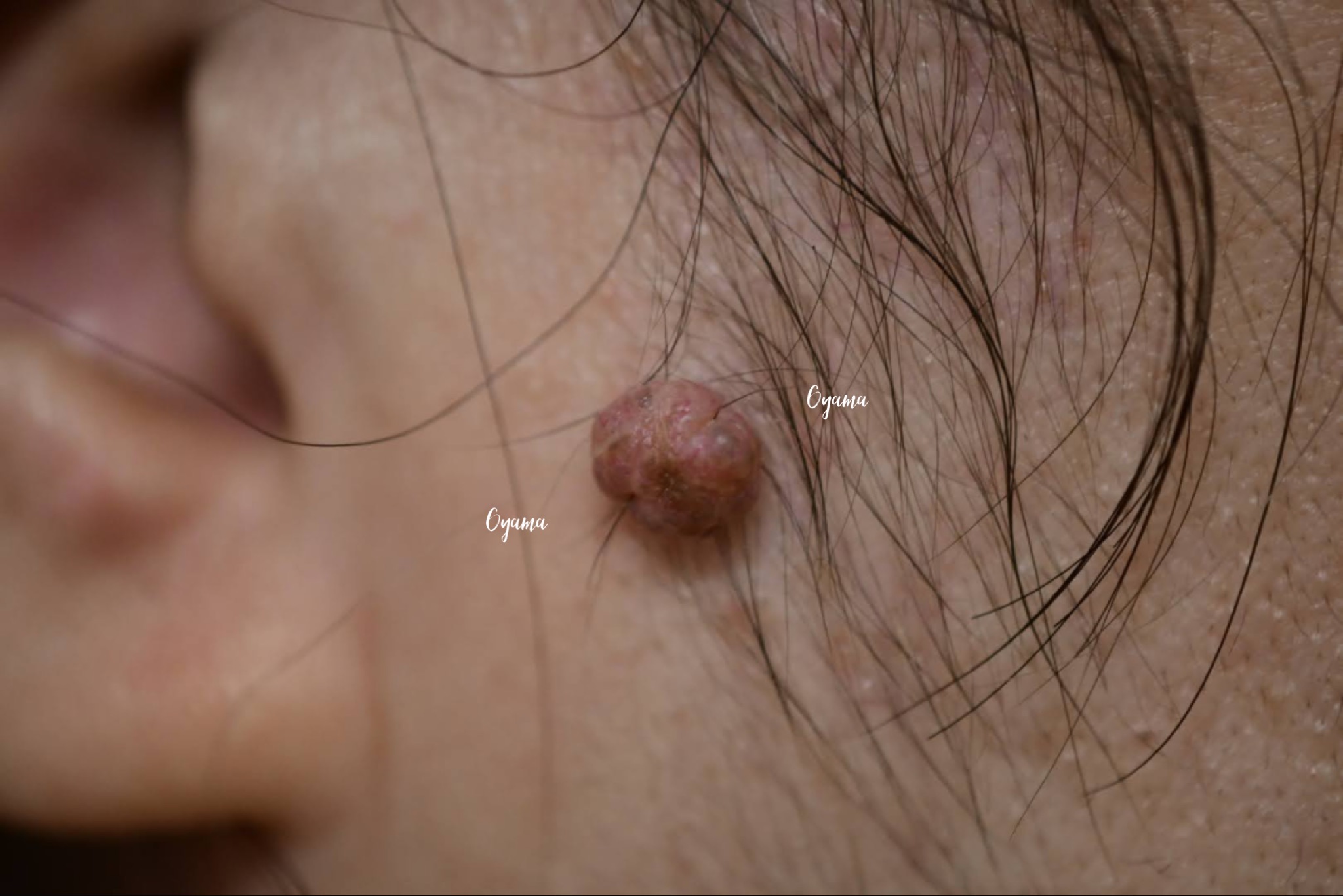 大きいほくろ除去