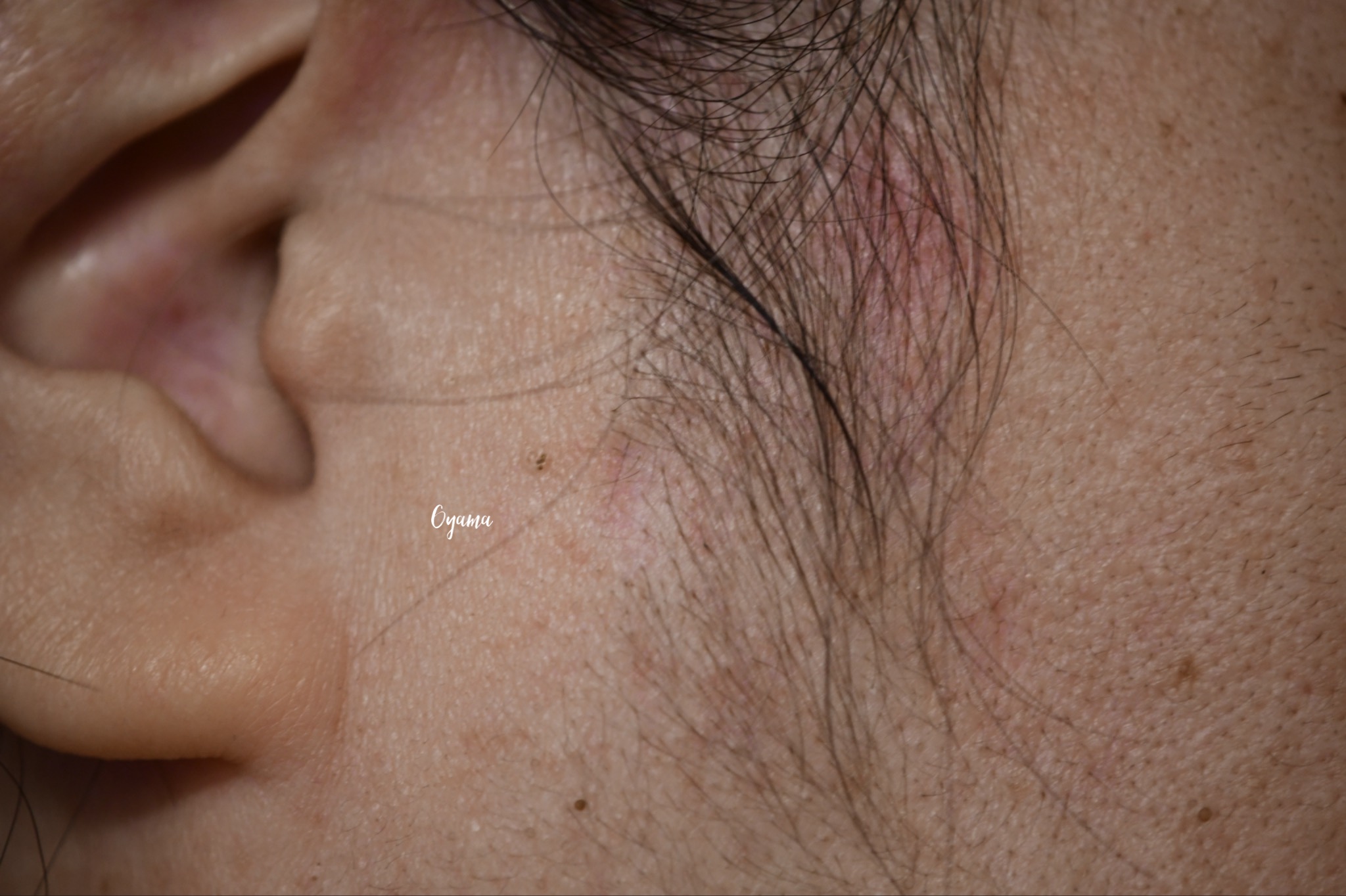 大きいほくろ除去