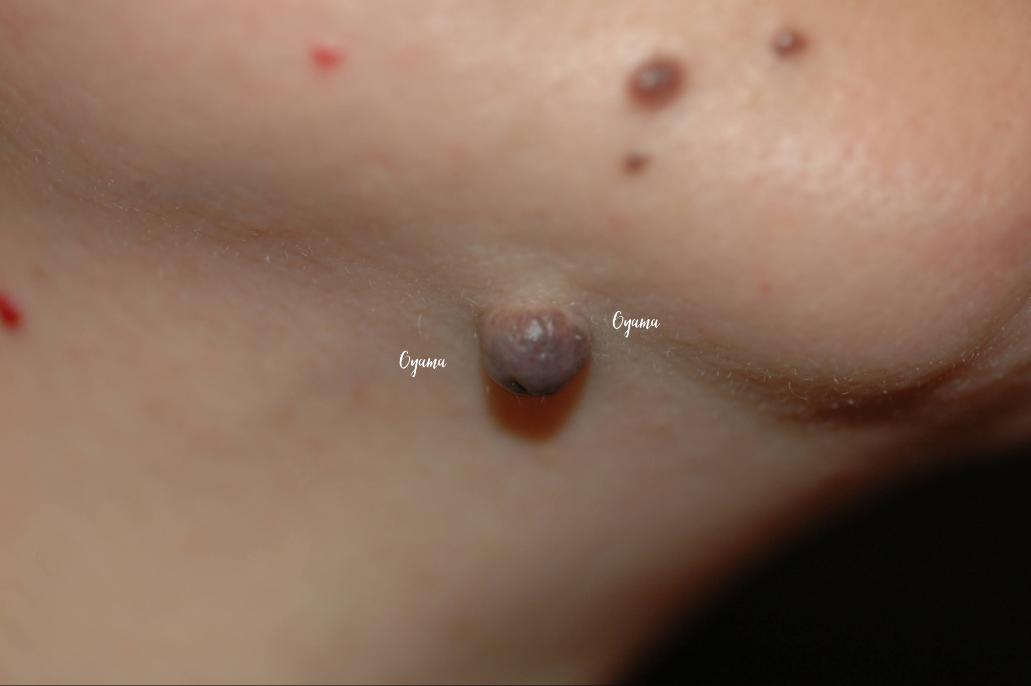 大きいほくろ除去