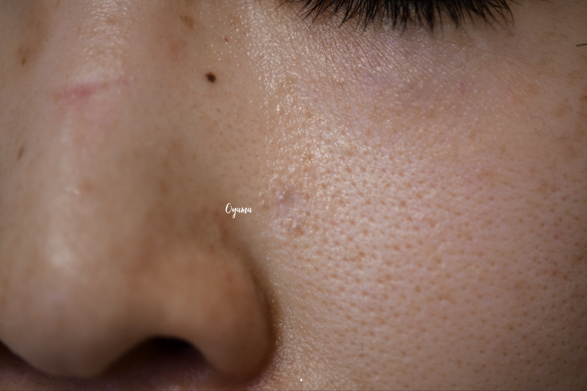 大きいほくろ除去