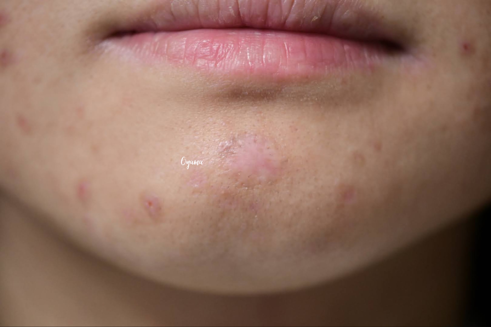 大きいほくろ除去