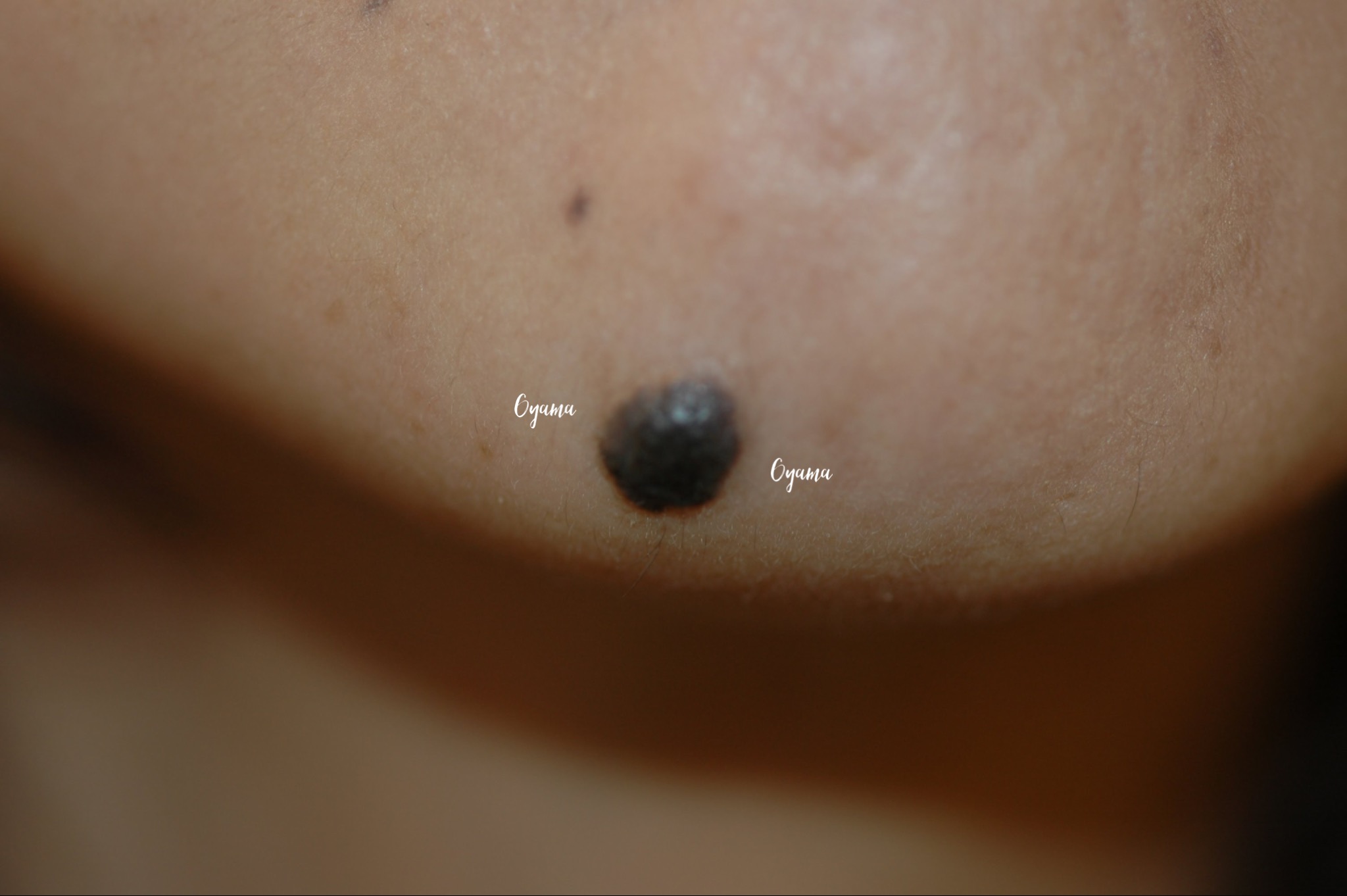 大きいほくろ除去