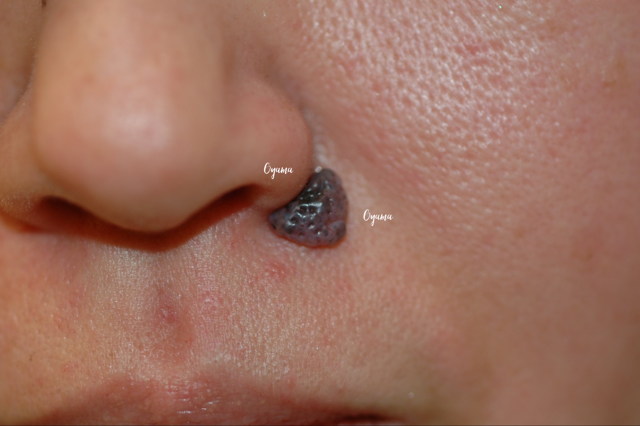 大きいほくろ除去