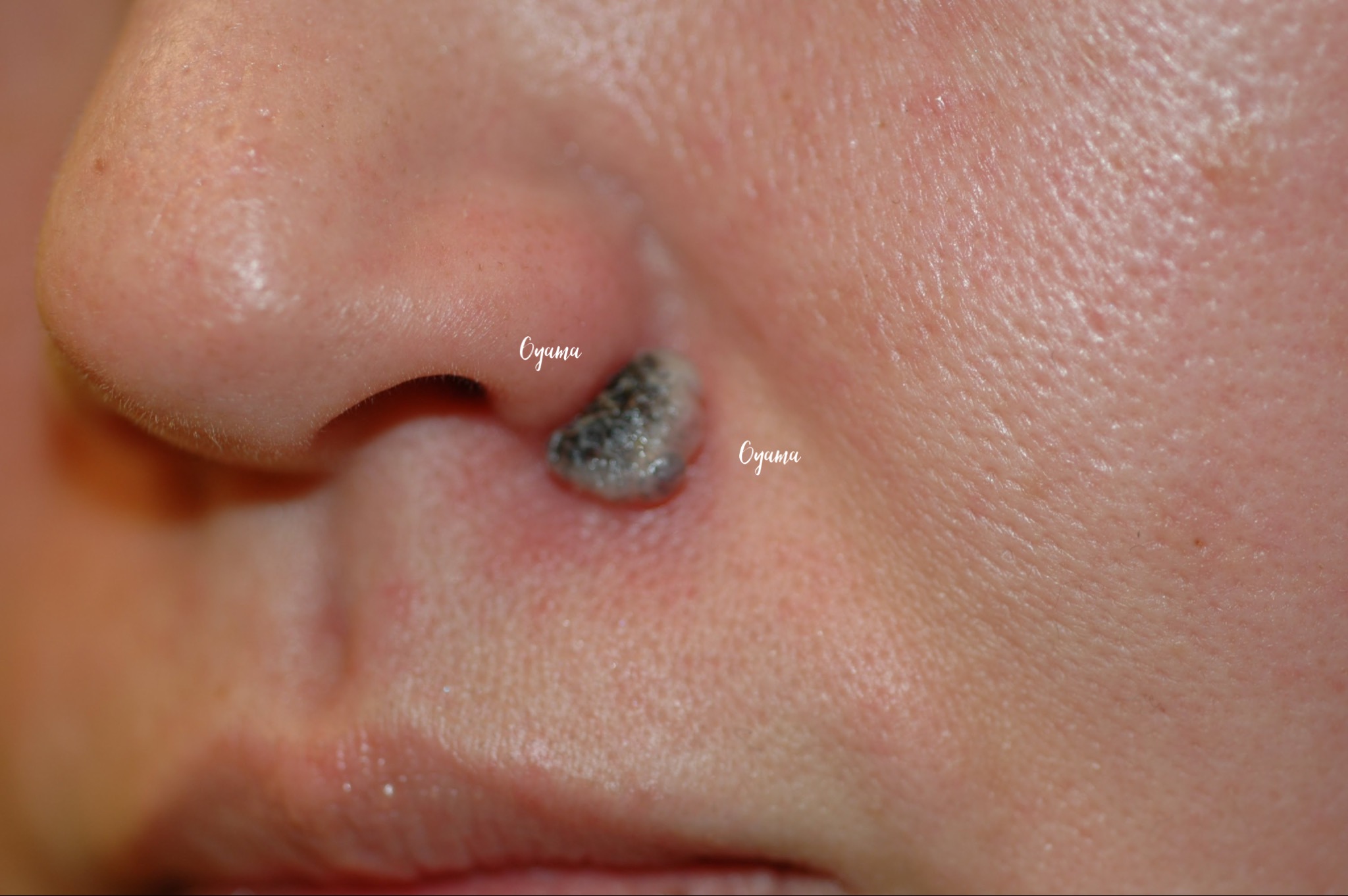 大きいほくろ除去