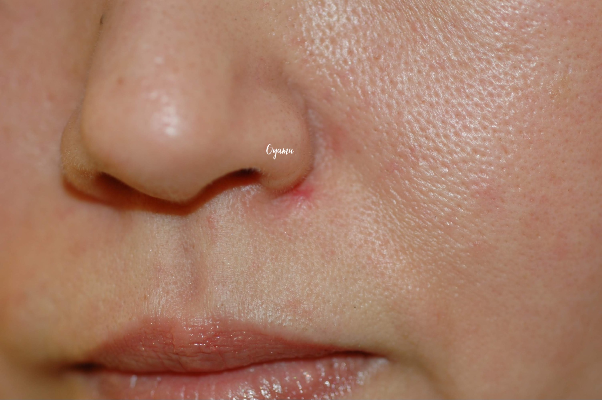 大きいほくろ除去