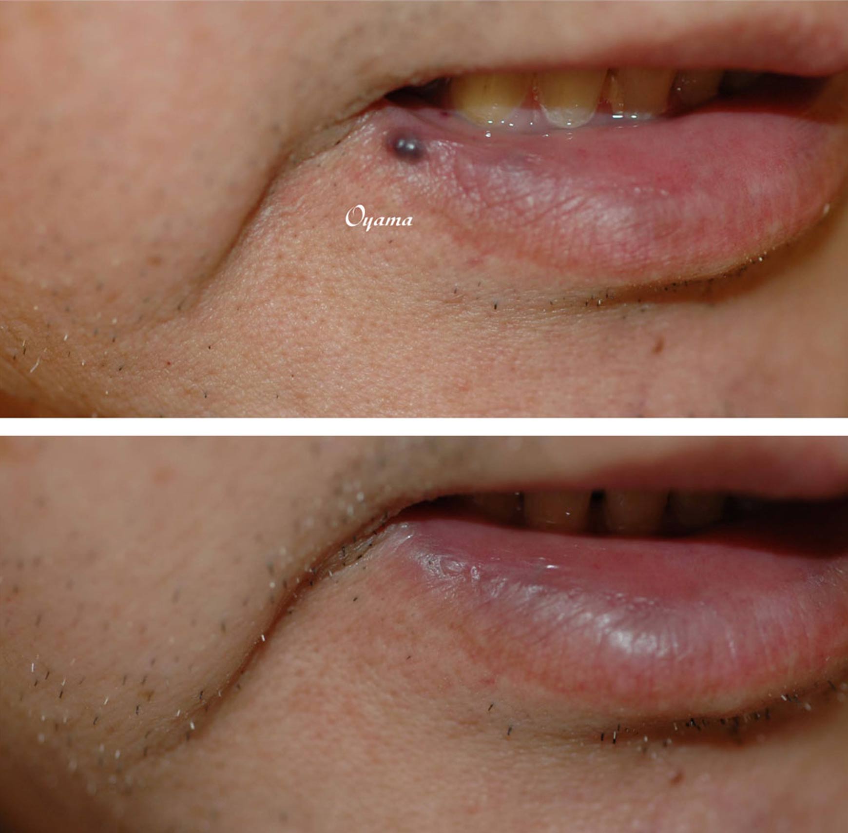 口唇(くちびる)のほくろ除去 症例