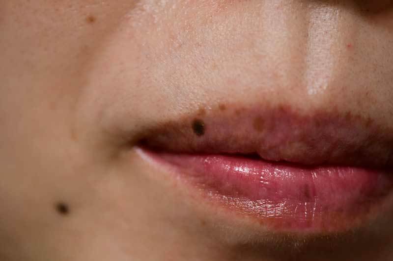 口唇(くちびる)のほくろ除去 症例
