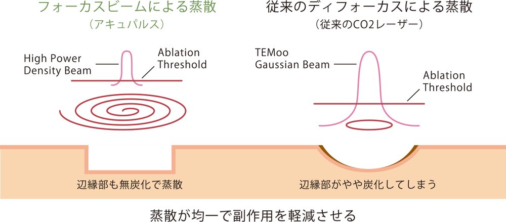 フォーカスビームによる蒸散（アキュパルス）と従来のディフォーカスによる蒸散の比較